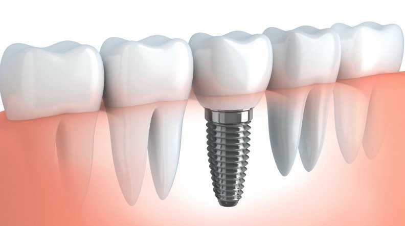 upload295implantologia dentale roma 1